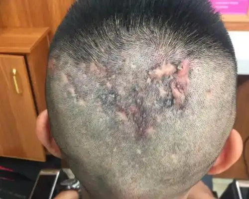 为何夏天头顶爱长疖子-别有病 byb.cn-纯自然疗法 攻克亚健康