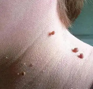 传染性软疣图片(脸上长小颗粒是怎么回事) - 赤虎壹号