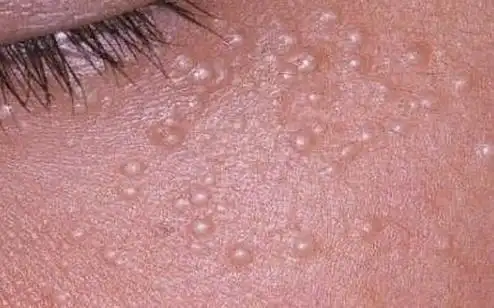 女性hpv病毒女性症状图片 各类型初期小疣体图片