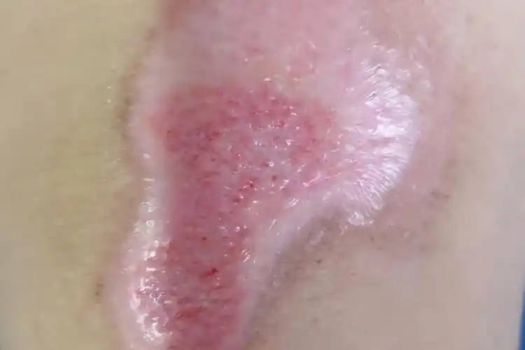 皮肤伤口愈合过程