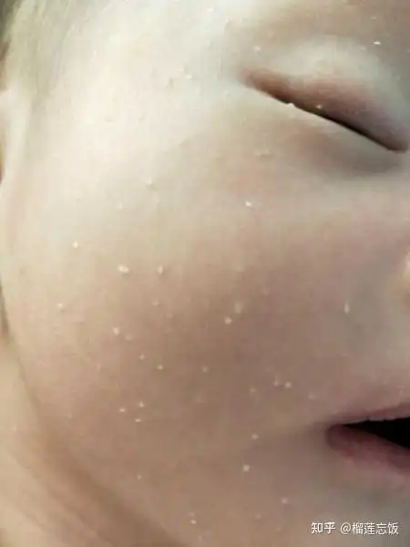 脸上的脂肪粒会自己脱落吗?有没有什么办法能快速去除呢? - 知乎