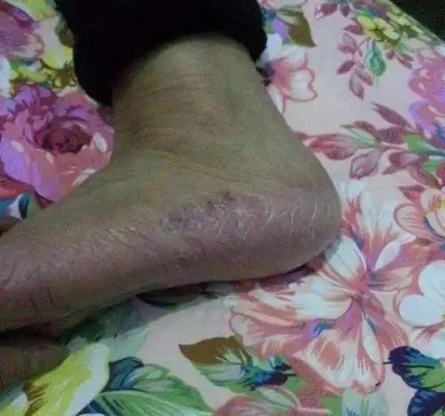 一旦双脚有这3种表现,十有八九是糖尿病足,三类人不要拒绝检查_血糖