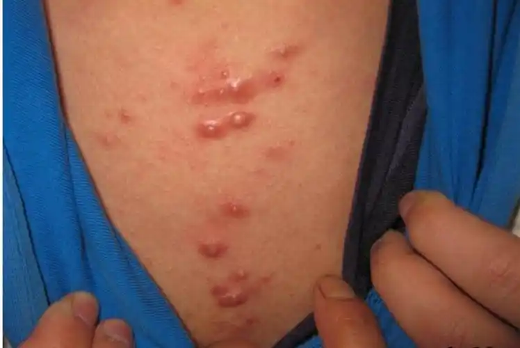 面部有轻度结节痤疮图片