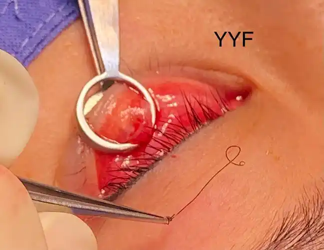 眼睑肿块系列之四&眼睑美容手术相关的霰粒肿_眼部疾病 - 好大夫在线