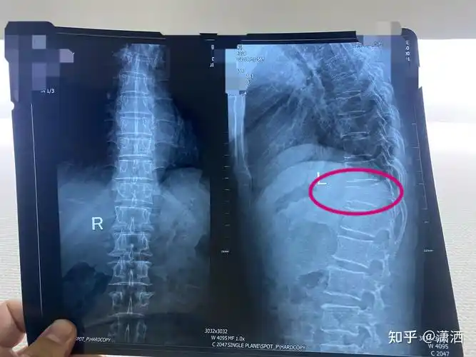 胸椎(t12)压缩性骨折治疗记录