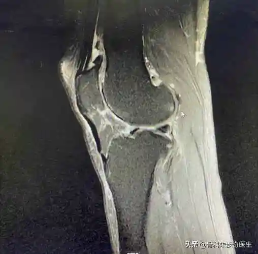 膝关节骨刺怎么治疗膝盖里面有骨刺最佳治疗方法