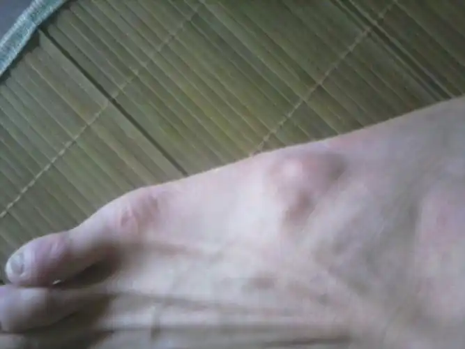 问:脚上突然发现一个小包,半年了,不痛不痒,我应该