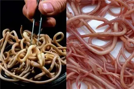 【图】蛔虫的症状有哪些 肚子疼痛的原因