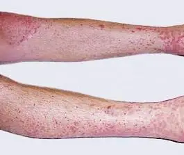 关于血管炎的病因有哪些你了解多少