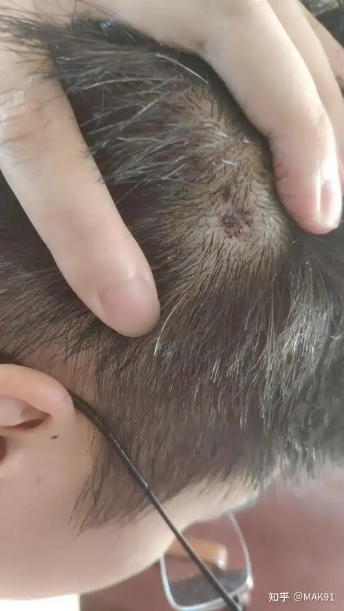 头皮上长了一个红色的小肉球不疼不痒的问一下是啥? - 知乎