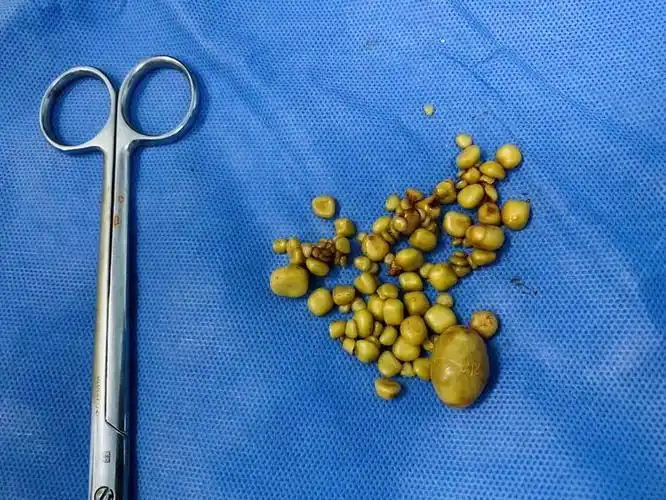 医院摄影好友实拍 胆囊结石