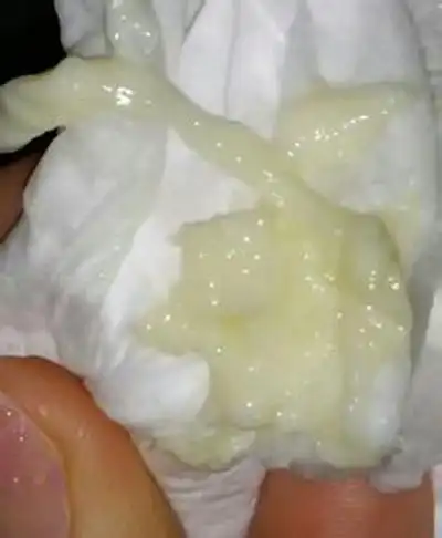 白带呈豆腐渣状图片6