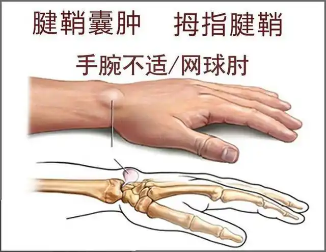 为啥说更年期女性更容易得腱鞘炎这些生活习惯请别忽视