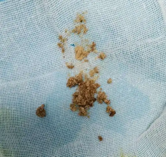 钬激光碎石后取石蓝取出的结石