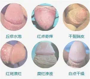 龟头痒小疙瘩龟头炎怎么治疗当心龟头炎带