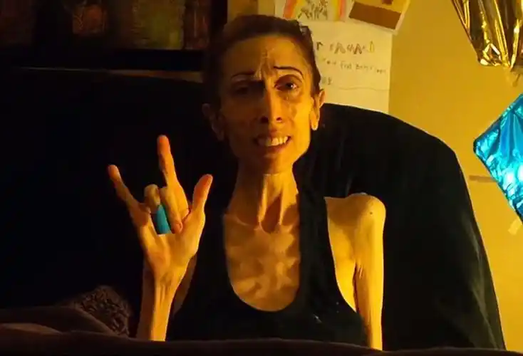 美国女演员患厌食症骨瘦如柴 体重仅18公斤(图)_环球要闻_湖南红网