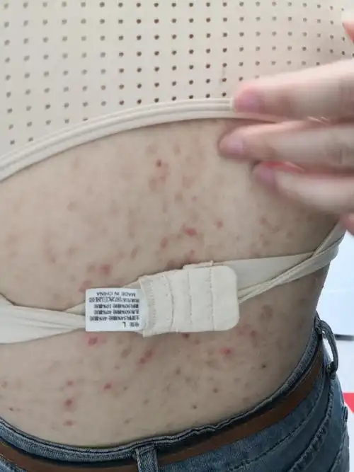 前胸后背散发红斑丘疹脓疱症状,是马拉色菌毛囊炎症状.