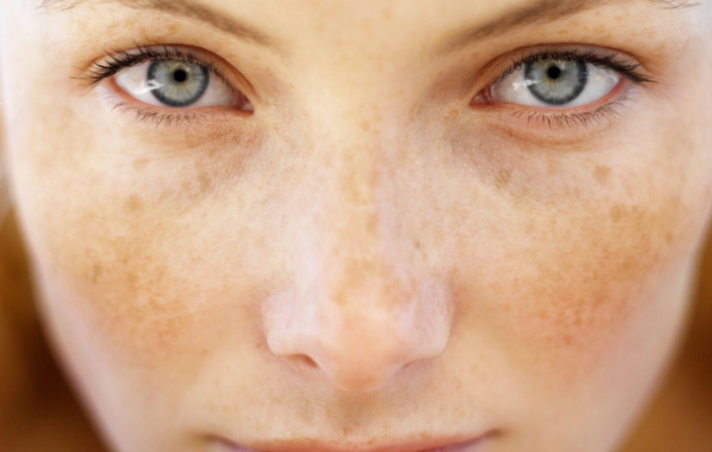 苹果绿 保健常识随着人体年龄的增长一些女性在脸上会出现黄褐斑和