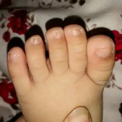 8个月女宝宝脚趾甲厚还有点发黄 两个脚中趾甲还拱着 不知道怎麼回事