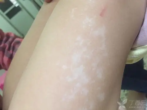 小孩大腿长 白斑 白癜风? - 皮肤性病 -丁香园论坛