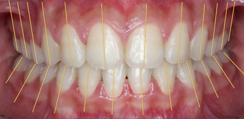 1 首先,牙齿的静态排列需要符合三维方向的标准.