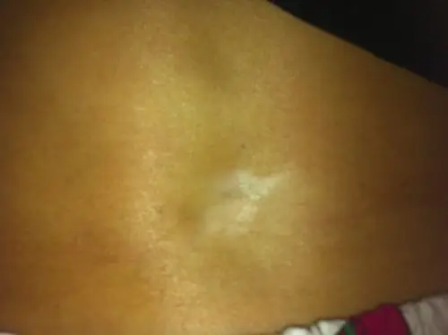 我妈腰部 腰椎有个凹陷的小坑 这是什么啊 严重不啊 他整天腰很酸疼