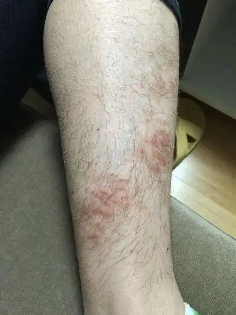 为什么一到冬天小腿就痒?