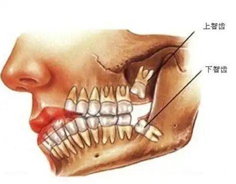 拔牙后牙洞愈合3d图