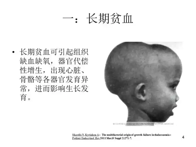 地中海贫血与生长发育相关性参考ppt
