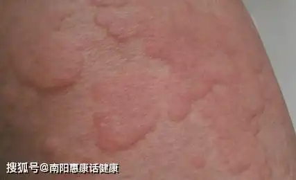 急性荨麻疹图片急性荨麻疹图片和症状是出现皮肤瘙痒和肿块,边缘模糊