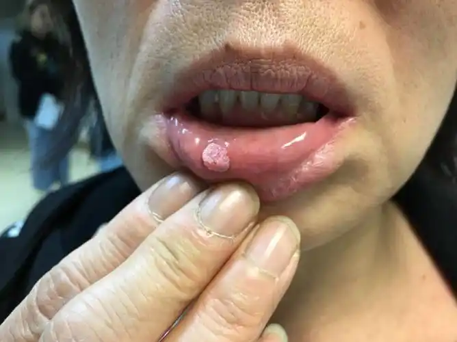 尖锐湿疣长什么样子?有什么症状?-高广程副主任医师-爱问医生