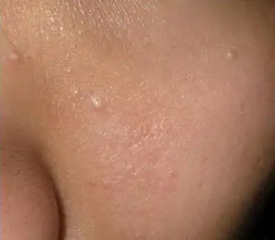 没错,脂肪粒并不是一种病症,它只是你的皮肤毛孔在膨胀后变大的样子