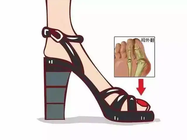 女子长期穿高跟鞋致双脚变形,高跟鞋这种东西就是反人类,特别是那种