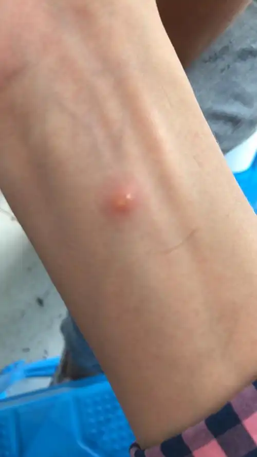 不知是什么虫子叮咬的,特别毒,都会形成水泡,奇痒无比!