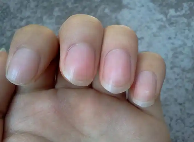 指甲盖上有竖纹,这是咋回事?真是老人说得"肝脏不好"?