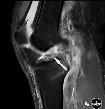 前交叉韧带损伤丨mri 征象_医学界-助力医生临床决策和职业成长