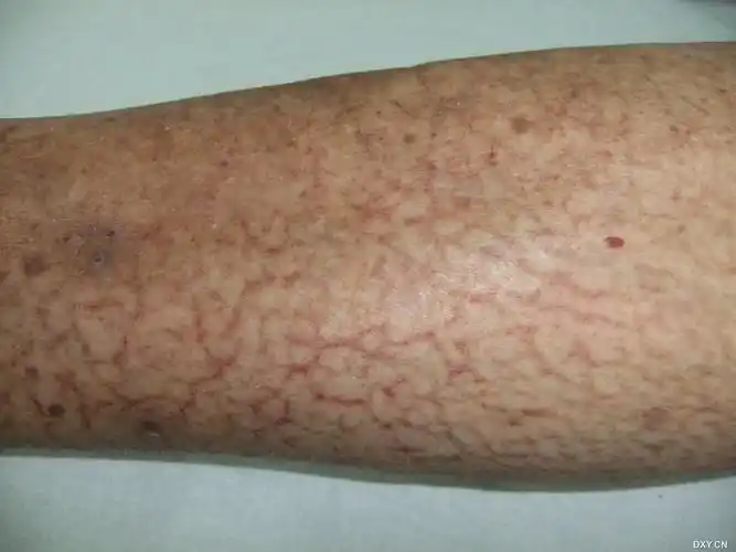 【请教】请问这个是网状青斑吗? - 风湿免疫 -丁香园论坛