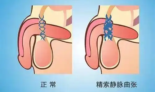 男性不育的杀手"精索静脉曲张",早发现早治疗