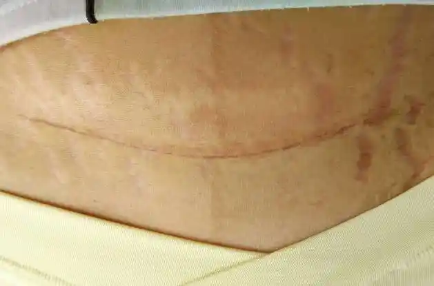 剖腹产"刀口"对女性损害有多大?产科医生说了3个后果,别忽视