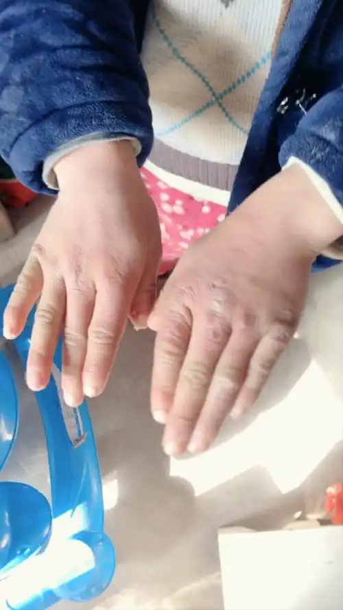看看这小手冻得.应该说是不听话.天冷老是往外跑,奶奶也看不住
