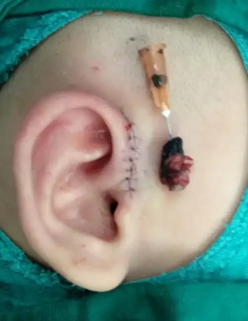 秦昊医生手记20180509先天性耳前瘘管切除