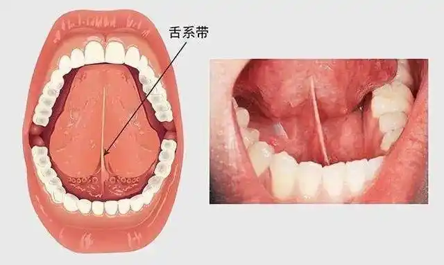 孩子舌系带过短?宝爸宝妈们要注意啦!