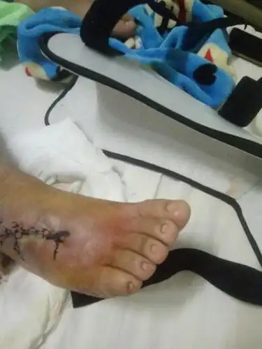 我被车撞了,右脚脚筋断裂两根,现在还在医院治疗,赔偿包括精神损失费