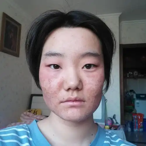 面部湿疹面部湿疹治疗记持续更新