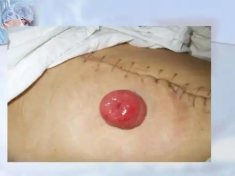 纤维瘤手术后悔死了,我6月3号做的乳腺纤维瘤手术