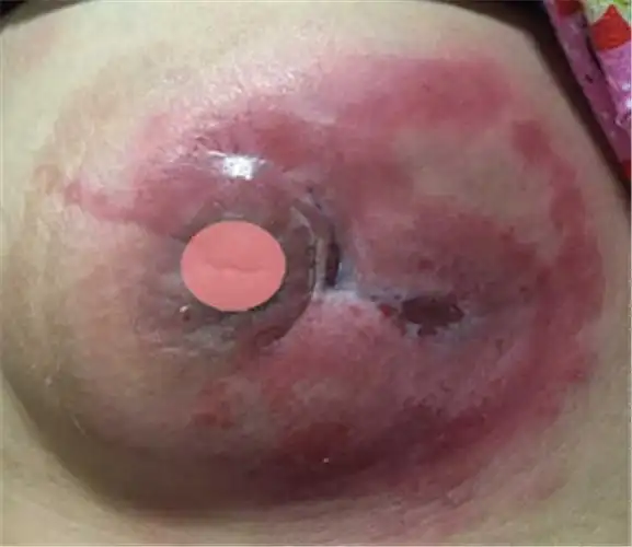 儋州市乳腺炎专家_儋州市治疗乳腺炎哪个专家好_儋州