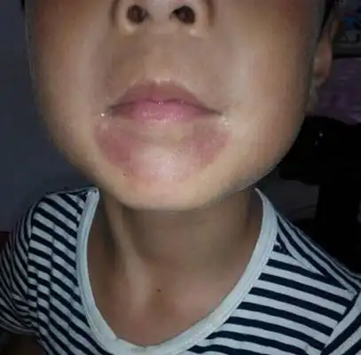 嘴唇发紫图片43