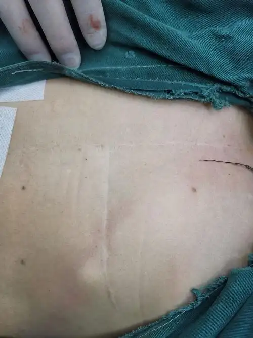 既往有腹部手术病史,切口自剑突一直到脐孔上缘,且有横向手术疤痕