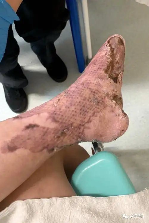 可怕英国25岁女子泡澡后被截肢医生再晚点命都没了