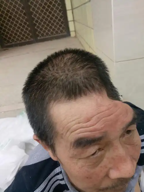 看看他的头左半部,已经没了头骨,凹陷了下去